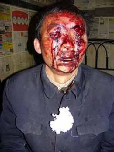 一中国男性上访公民，因戴白花悼赵紫阳，右眼球被打出